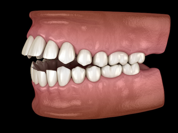 出っ歯の模型