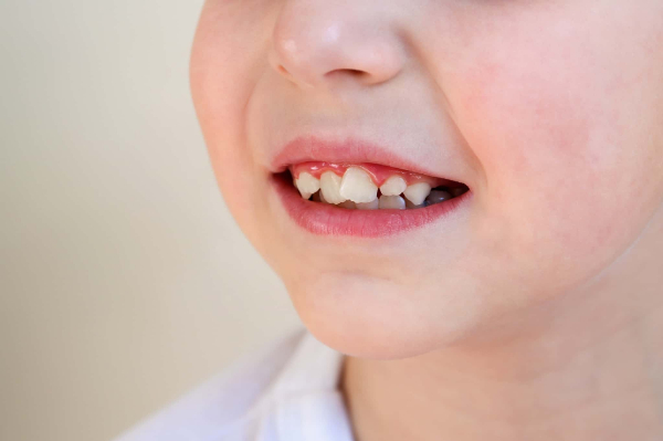 矯正の検討が必要な歯並びの悪い子ども