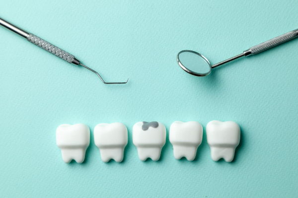 虫歯治療のイメージ