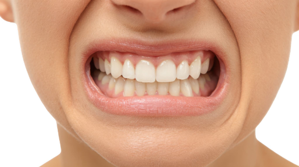 矯正用のマウスピースが割れる主な原因になる歯ぎしりのイメージ