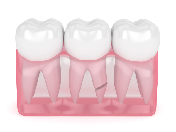 歯がぐらつく原因になる歯根破折のイメージ