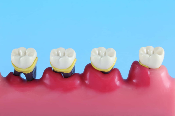 歯周病の進行イメージ