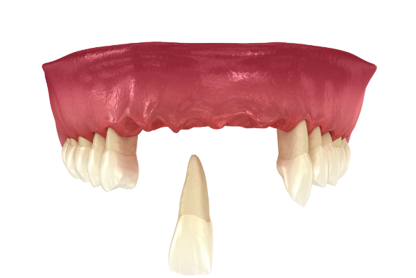 ぐらつく歯を放置して歯が抜け落ちるイメージ