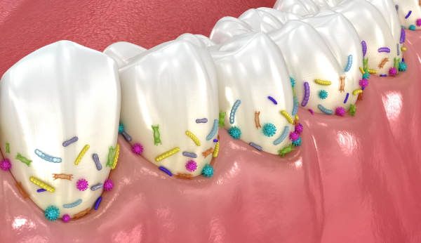 歯垢にいる細菌で歯周病になるイメージ