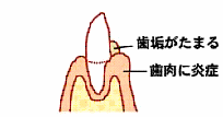 歯周病の流れ1